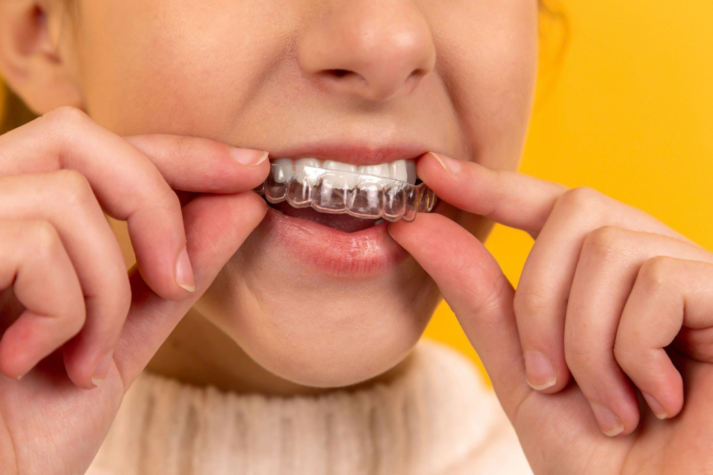 A person placing a clear aligner tray over their teeth